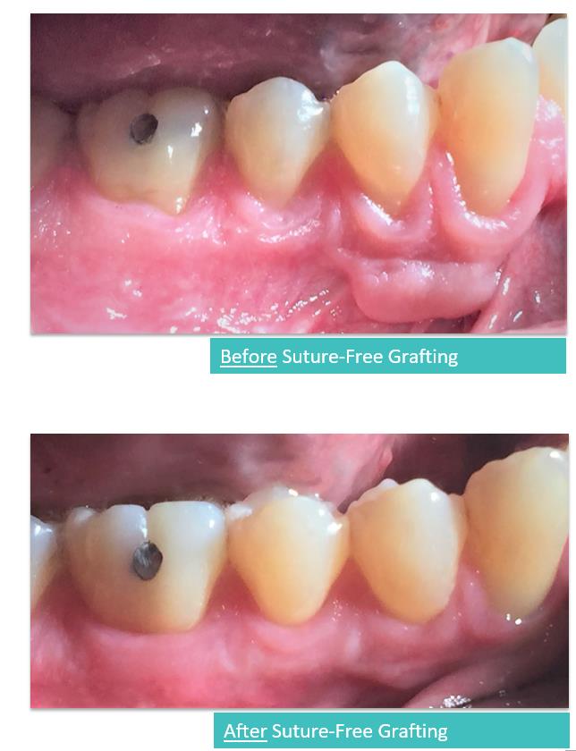 Suture-Free Gum Grafting 10a