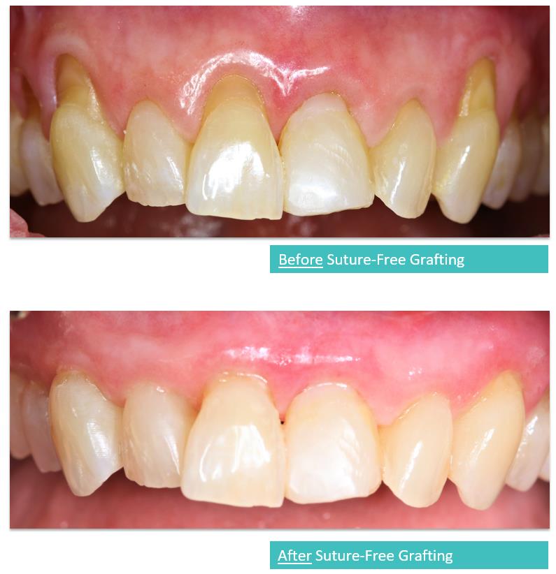 Suture-Free Gum Grafting 11a