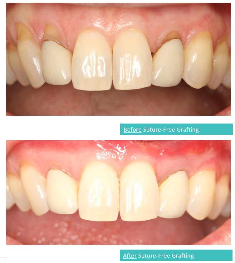 Suture-Free Gum Grafting 12a