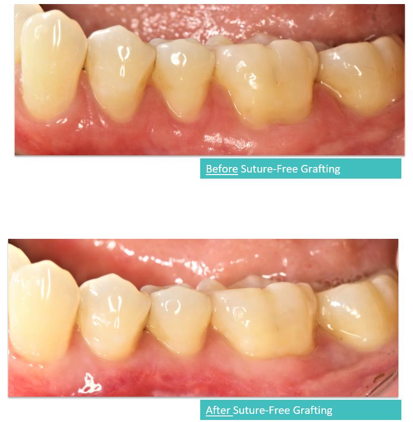 Suture-Free Gum Grafting 2a