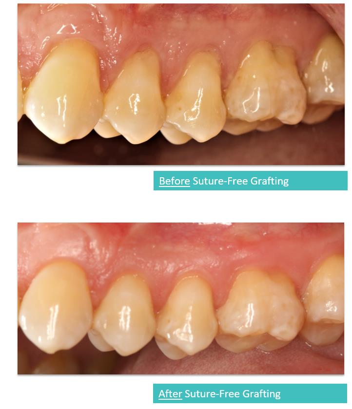 Suture-Free Gum Grafting 3a