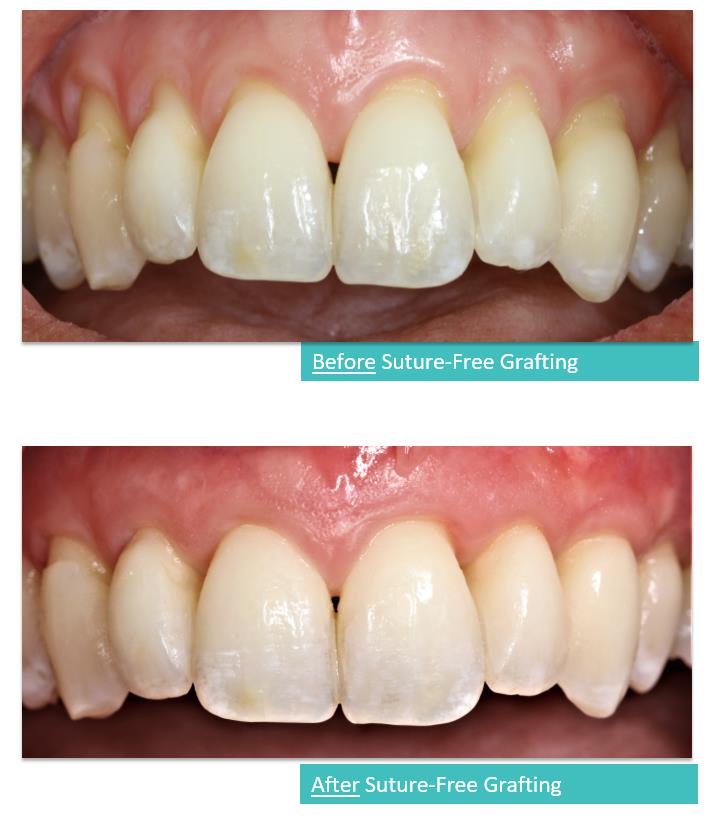 Suture-Free Gum Grafting 4a