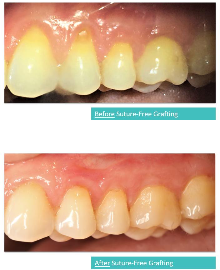 Suture-Free Gum Grafting 5a