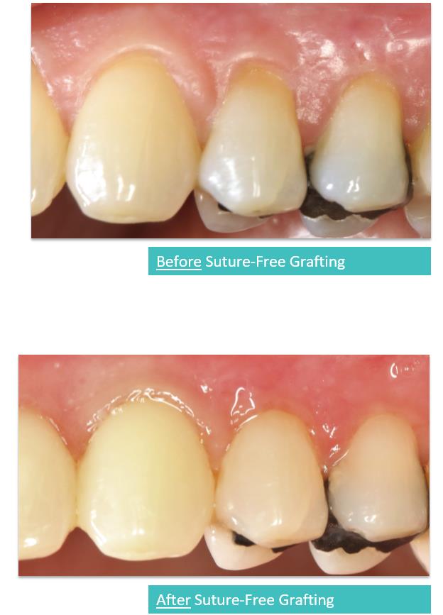 Suture-Free Gum Grafting 7a