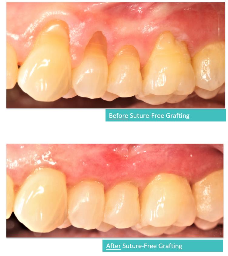 Suture-Free Gum Grafting 8a