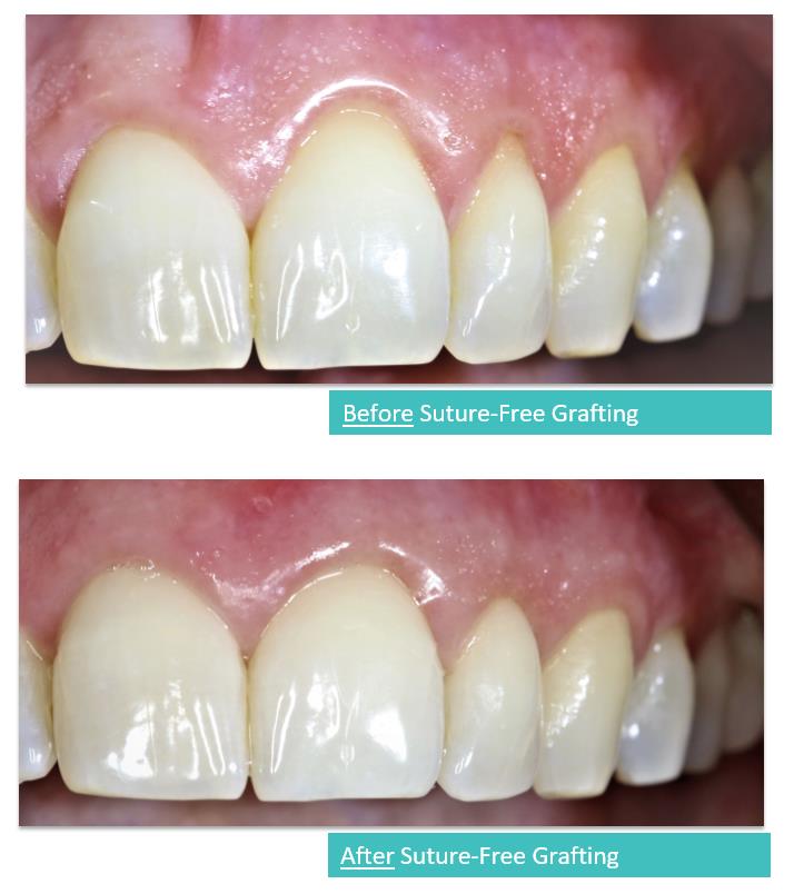 Suture-Free Gum Grafting